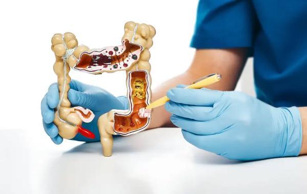 بررسی انواع پولیپ روده و رژیم غذایی مناسب آن آنالیز انواع پولیپ روده و رژیم غذایی مناسب آن