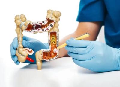 آنالیز انواع پولیپ روده و رژیم غذایی مناسب آن
